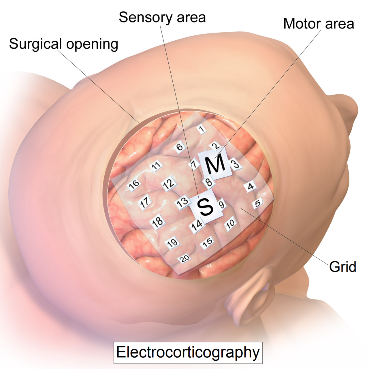 China implanta electrodos cerebrales para controlar dispositivos con el pensamiento